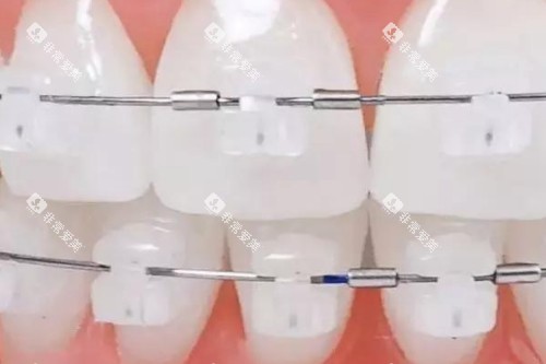 陶瓷半隐形矫正模型图 陶瓷半隐形矫正模型图