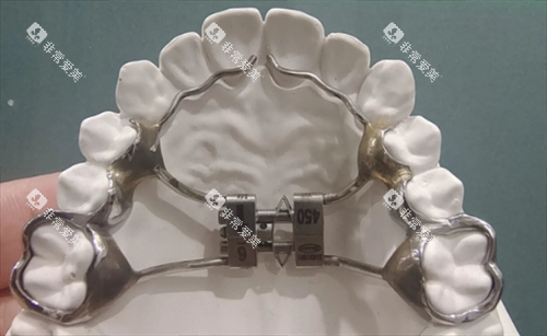 记忆簧固定扩弓器