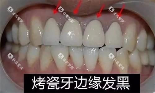 烤瓷牙边缘发黑