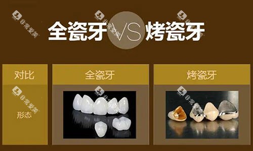 烤瓷牙和全瓷牙对比展示图