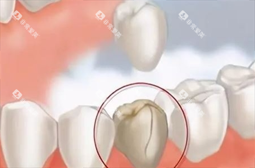 重度龋齿需要做嵌体的情况