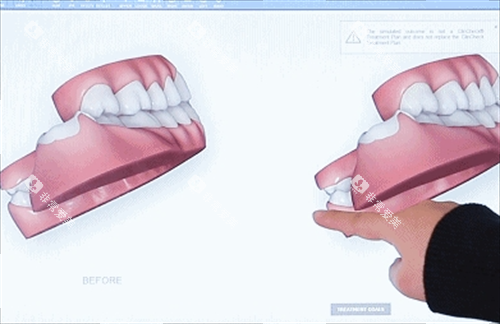 隐形牙齿矫正3D模型展示
