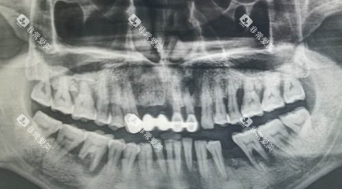 口腔缺牙ct