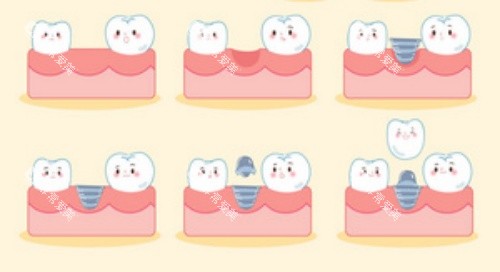 种牙流程示意图 种牙流程示意图