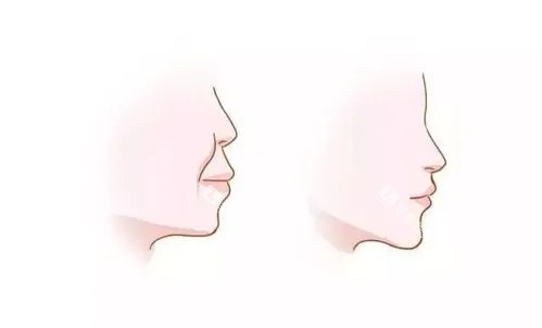 凸嘴示意图 凸嘴示意图