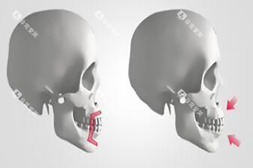 凸嘴手术示意图 凸嘴手术示意图