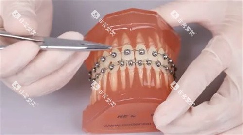 球面自锁托槽矫正怎么做的 球面自锁托槽矫正怎么做的