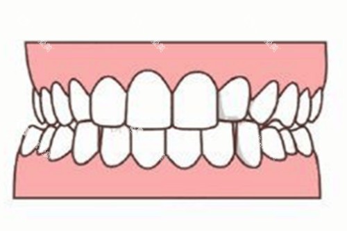 牙齿轻微畸形卡通图 牙齿轻微畸形卡通图