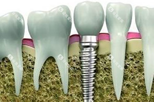 种植牙和真牙牙根对比示意图