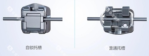 牙齿矫正自锁托槽示意图 牙齿矫正自锁托槽示意图