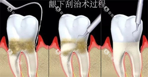 龈下刮治过程