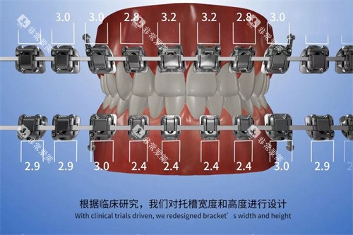 欧晴自锁托槽 (8) 欧晴自锁托槽 (8)