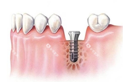 种植体植入步骤图