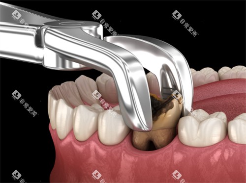拔掉龋坏的牙齿 拔掉龋坏的牙齿