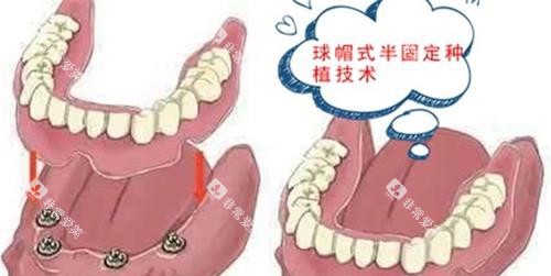 漫画半口种植牙示意图