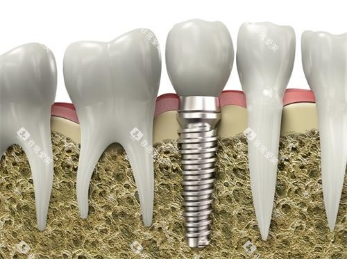 种植牙牙槽骨照片