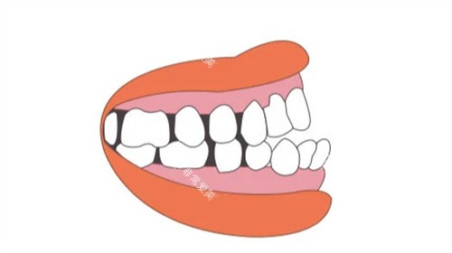 地包天侧面 地包天侧面