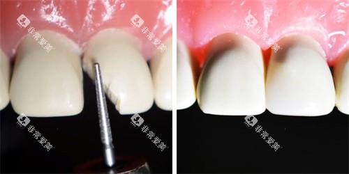 断裂的门牙修复对比