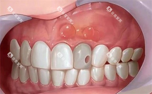 根尖囊肿是什么卡通图