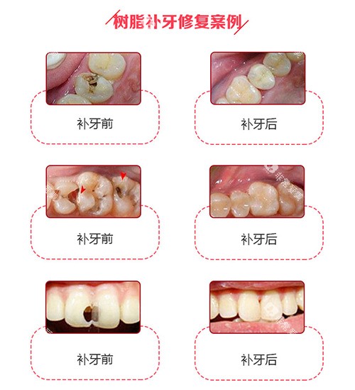 树脂补牙修复实例 树脂补牙修复实例