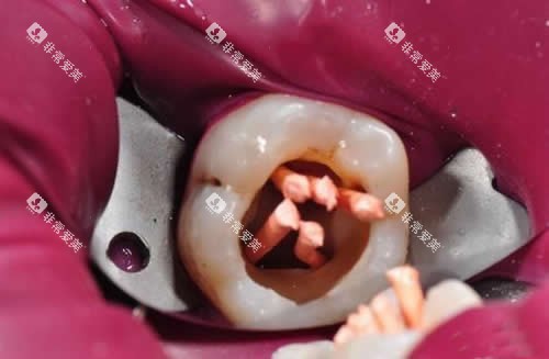 根管治疗细节图片