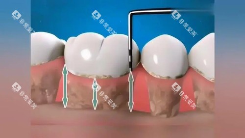 牙周刮治漫画图