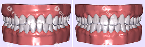 牙齿矫正模拟图前后对比 牙齿矫正模拟图前后对比