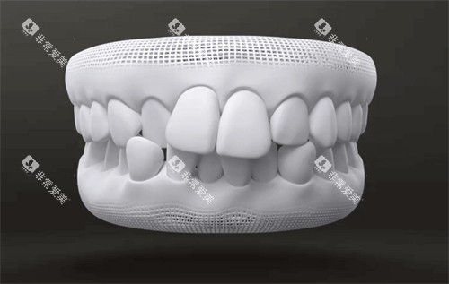 牙齿畸形图示 牙齿畸形图示