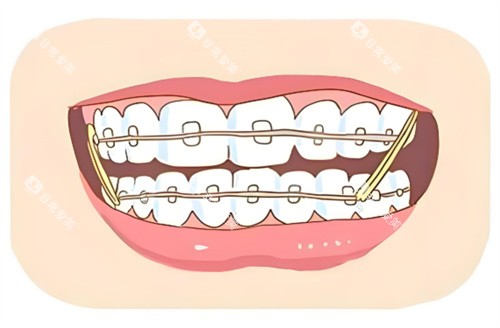 矫正牙套 矫正牙套