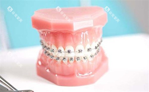 金属自锁牙套 金属自锁牙套