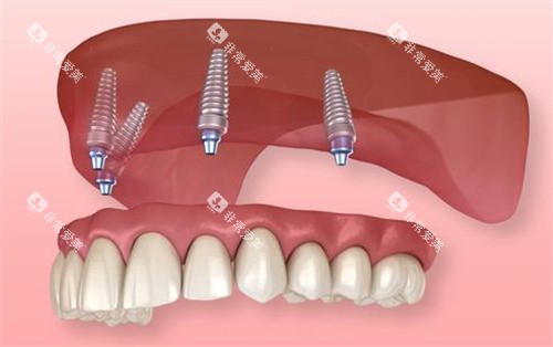 半固定种植牙动画图