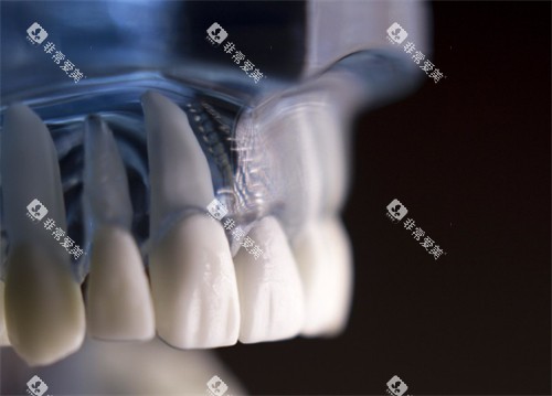 扬州杨京口腔种牙动画图示