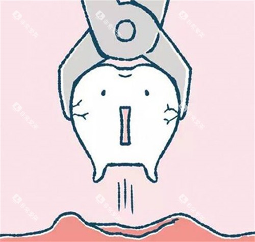 牙齿拔除过程展示 牙齿拔除过程展示