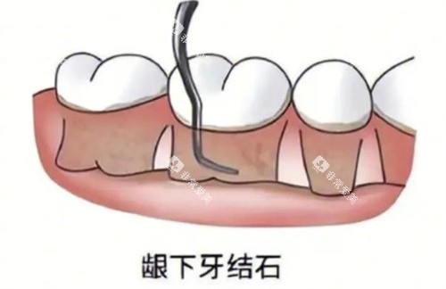 龈下刮治