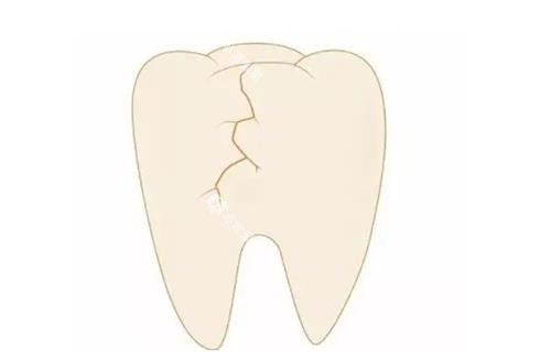 牙齿裂纹卡通示意图 牙齿裂纹卡通示意图