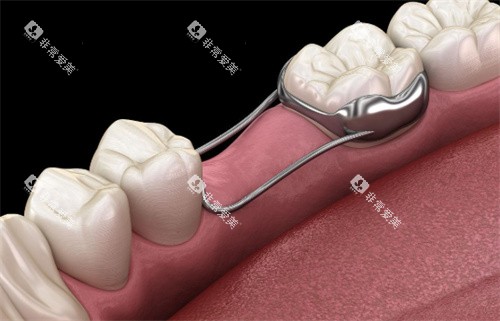 牙齿间隙保持器