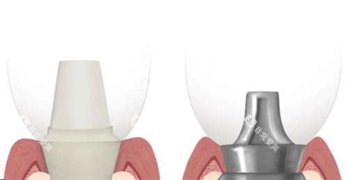 瑞士百丹特种植牙基台连接对比 瑞士百丹特种植牙基台连接对比