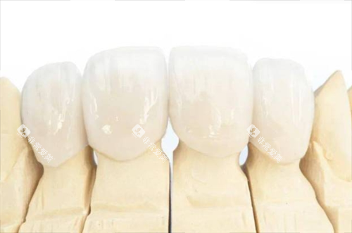 全瓷牙冠佩戴模型展示 全瓷牙冠佩戴模型展示