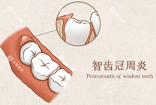 智齿冠周炎漫画示意图 智齿冠周炎漫画示意图