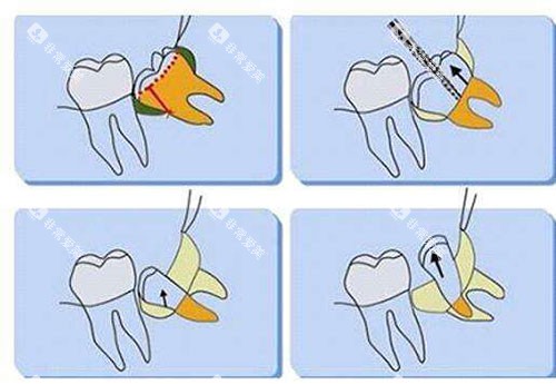 不同智齿类型实验题 不同智齿类型实验题