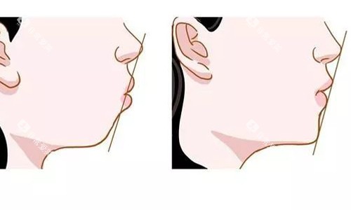 深覆合牙齿矫正前后整体对比图 深覆合牙齿矫正前后整体对比图