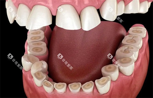 牙齿磨平展示图 牙齿磨平展示图