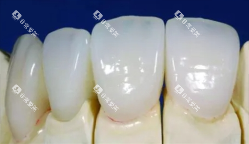 钯金烤瓷牙牙模型展示 钯金烤瓷牙牙模型展示