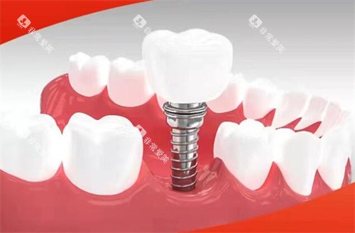 赣州金铂利口腔种植牙