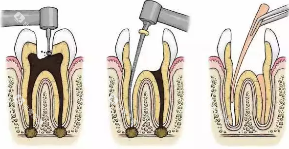 根管治疗过程 根管治疗过程
