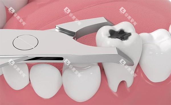 坏牙拔出照片 坏牙拔出照片