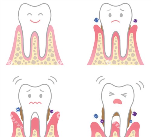 牙齿松动解决办法 牙齿松动解决办法