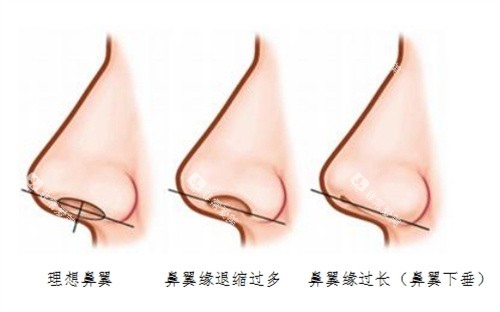 鼻翼退缩矫正术图片实例 鼻翼退缩矫正术图片实例