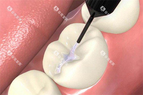 窝沟封闭剂涂抹 窝沟封闭剂涂抹