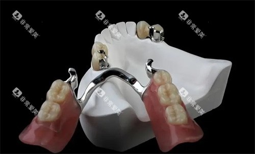 精密附着体义齿是什么